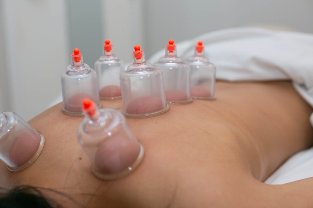 Cupping Therapy